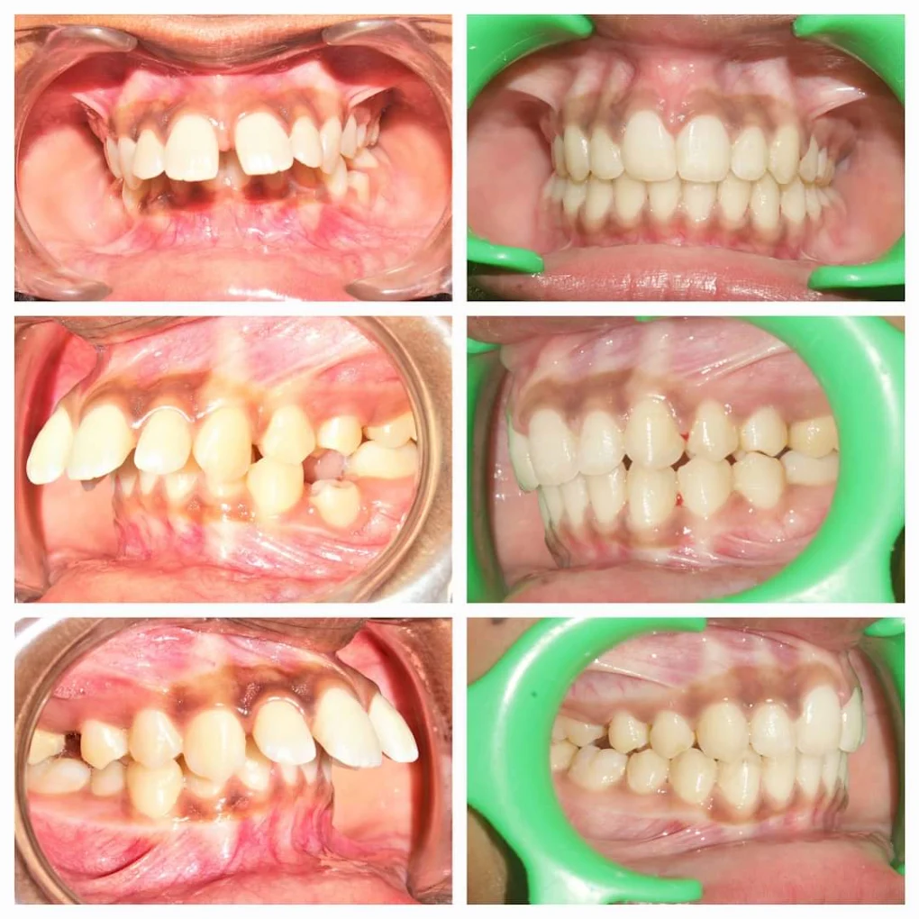 Teeth alignment case — before and after treatment at DENTA ZONE