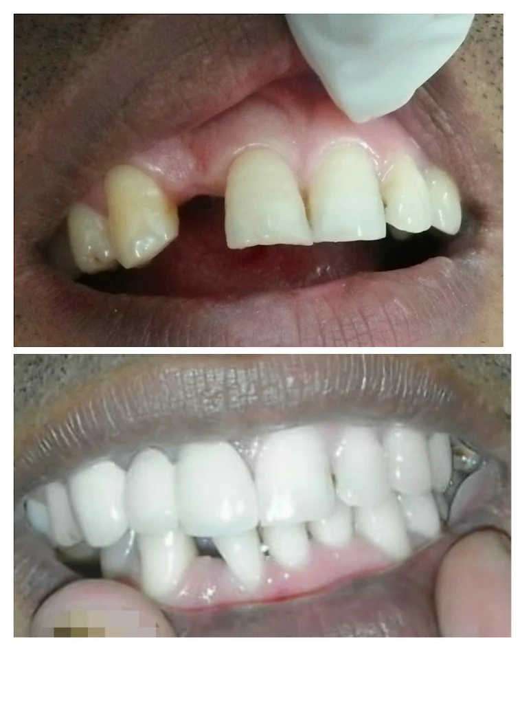 Tooth replacement case — before and after treatment at DENTA ZONE