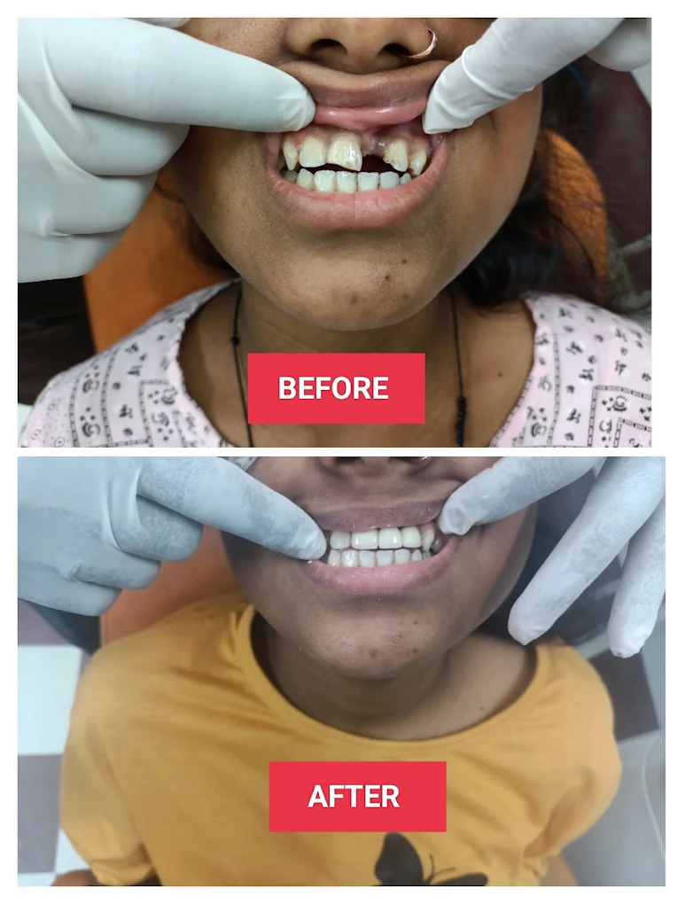 Front teeth treatment case — before and after treatment at DENTA ZONE