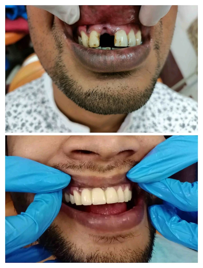 Missing front tooth case — before and after treatment at DENTA ZONE