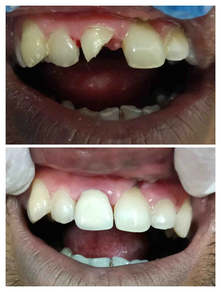 Damaged front tooth case — before and after treatment at DENTA ZONE