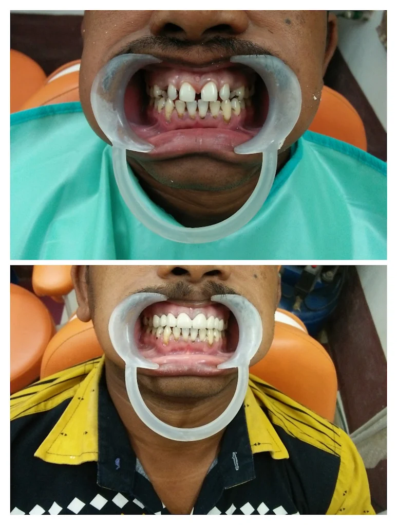 Full smile treatment case — before and after treatment at DENTA ZONE